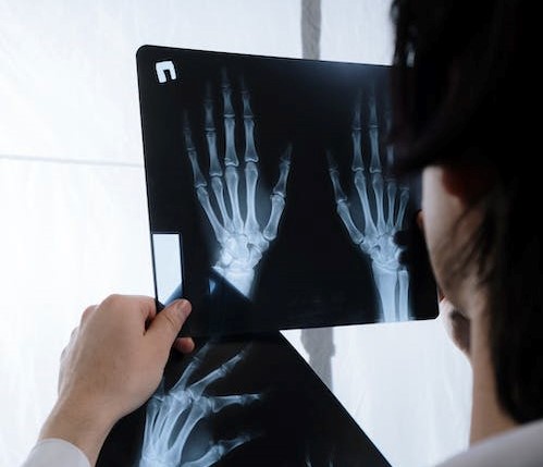 JESTE LI ZNALI? Najvažniji rizični čimbenik za razvoj osteoporoze počinje oko tridesete godine života