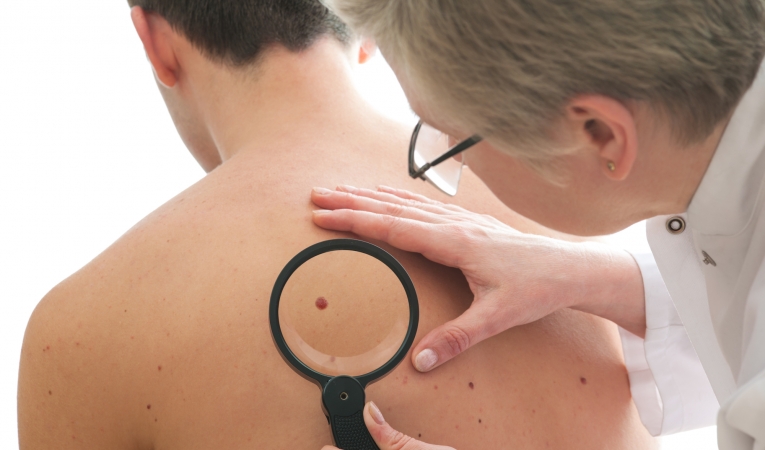 U sklopu akcije #SaveYourSkin u Umagu će se održati besplatni pregled madeža NA ČETVROM SMO MJESTU PO SMRTNOSTI